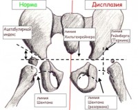 Congenital_dislocation_of_the_hip_2.jpg